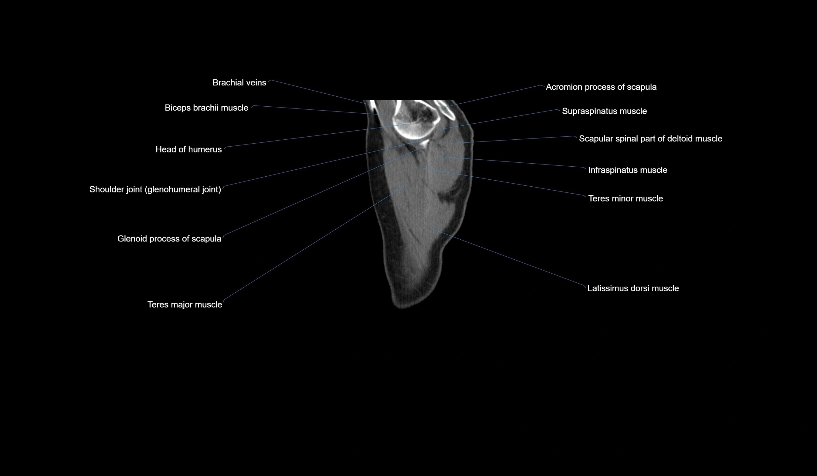 CT chest (thorax) soft tissue window labelled sagittal cross sectional anatomy radiology image-00005.webp